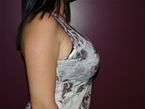 Breast Augmentation After Photo by Moneer Jaibaji, MD; Coronado, CA - Case 22928