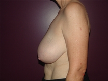 Breast Reduction Before Photo by Moneer Jaibaji, MD; Coronado, CA - Case 23017