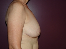Breast Reduction After Photo by Moneer Jaibaji, MD; Coronado, CA - Case 23017