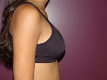 Breast Augmentation After Photo by Moneer Jaibaji, MD; Coronado, CA - Case 23056
