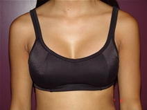 Breast Augmentation Before Photo by Moneer Jaibaji, MD; Coronado, CA - Case 23056