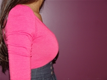 Breast Augmentation After Photo by Moneer Jaibaji, MD; Coronado, CA - Case 23056