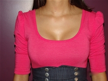 Breast Augmentation Before Photo by Moneer Jaibaji, MD; Coronado, CA - Case 23056