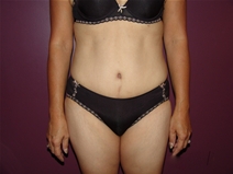 Tummy Tuck After Photo by Moneer Jaibaji, MD; Coronado, CA - Case 23057