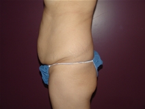 Tummy Tuck Before Photo by Moneer Jaibaji, MD; Coronado, CA - Case 23057