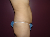 Tummy Tuck Before Photo by Moneer Jaibaji, MD; Coronado, CA - Case 23057