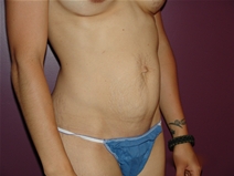 Tummy Tuck Before Photo by Moneer Jaibaji, MD; Coronado, CA - Case 23058