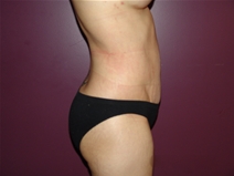 Tummy Tuck After Photo by Moneer Jaibaji, MD; Coronado, CA - Case 23058