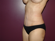 Tummy Tuck After Photo by Moneer Jaibaji, MD; Coronado, CA - Case 23058