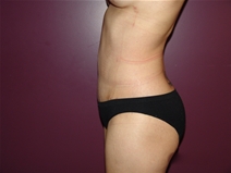 Tummy Tuck After Photo by Moneer Jaibaji, MD; Coronado, CA - Case 23058