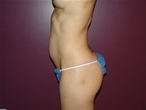 Tummy Tuck Before Photo by Moneer Jaibaji, MD; Coronado, CA - Case 23058