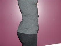 Tummy Tuck After Photo by Moneer Jaibaji, MD; Coronado, CA - Case 23058