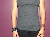 Tummy Tuck Before Photo by Moneer Jaibaji, MD; Coronado, CA - Case 23058