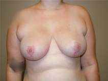 Breast Reduction After Photo by Moneer Jaibaji, MD; Coronado, CA - Case 23142