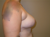 Breast Reduction After Photo by Moneer Jaibaji, MD; Coronado, CA - Case 23142