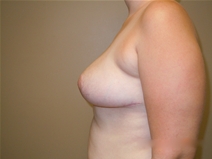 Breast Reduction After Photo by Moneer Jaibaji, MD; Coronado, CA - Case 23142