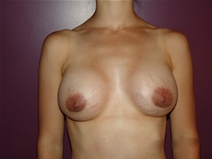 Breast Augmentation After Photo by Moneer Jaibaji, MD; Coronado, CA - Case 23143