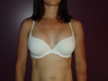 Breast Augmentation Before Photo by Moneer Jaibaji, MD; Coronado, CA - Case 23143