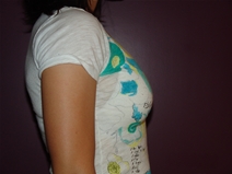 Breast Augmentation Before Photo by Moneer Jaibaji, MD; Coronado, CA - Case 23143