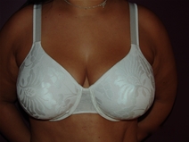 Breast Augmentation After Photo by Moneer Jaibaji, MD; Coronado, CA - Case 23144