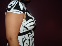 Breast Augmentation After Photo by Moneer Jaibaji, MD; Coronado, CA - Case 23144