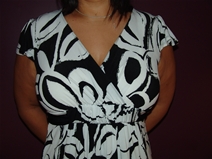 Breast Augmentation Before Photo by Moneer Jaibaji, MD; Coronado, CA - Case 23144