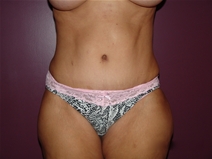 Tummy Tuck After Photo by Moneer Jaibaji, MD; Coronado, CA - Case 23145
