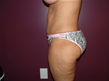 Tummy Tuck After Photo by Moneer Jaibaji, MD; Coronado, CA - Case 23145