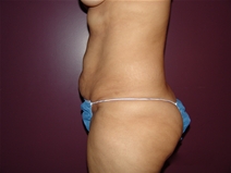Tummy Tuck Before Photo by Moneer Jaibaji, MD; Coronado, CA - Case 23145