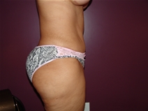 Tummy Tuck After Photo by Moneer Jaibaji, MD; Coronado, CA - Case 23145
