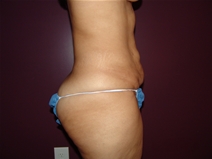 Tummy Tuck Before Photo by Moneer Jaibaji, MD; Coronado, CA - Case 23145