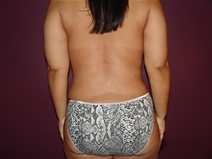 Tummy Tuck After Photo by Moneer Jaibaji, MD; Coronado, CA - Case 23145