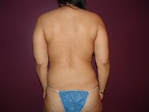 Tummy Tuck Before Photo by Moneer Jaibaji, MD; Coronado, CA - Case 23145