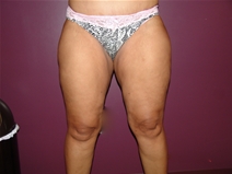 Liposuction After Photo by Moneer Jaibaji, MD; Coronado, CA - Case 23146