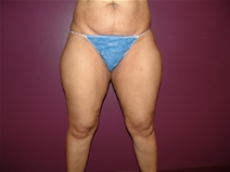 Liposuction Before Photo by Moneer Jaibaji, MD; Coronado, CA - Case 23146