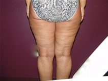 Liposuction After Photo by Moneer Jaibaji, MD; Coronado, CA - Case 23146