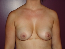 Breast Augmentation Before Photo by Moneer Jaibaji, MD; Coronado, CA - Case 23167