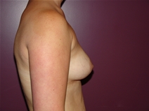 Breast Augmentation Before Photo by Moneer Jaibaji, MD; Coronado, CA - Case 23167