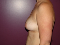 Breast Augmentation Before Photo by Moneer Jaibaji, MD; Coronado, CA - Case 23167