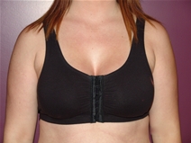 Breast Augmentation After Photo by Moneer Jaibaji, MD; Coronado, CA - Case 23167