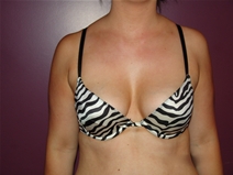 Breast Augmentation Before Photo by Moneer Jaibaji, MD; Coronado, CA - Case 23167