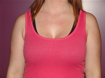 Breast Augmentation After Photo by Moneer Jaibaji, MD; Coronado, CA - Case 23167