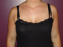 Breast Augmentation Before Photo by Moneer Jaibaji, MD; Coronado, CA - Case 23167