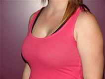 Breast Augmentation After Photo by Moneer Jaibaji, MD; Coronado, CA - Case 23167