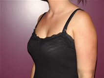 Breast Augmentation Before Photo by Moneer Jaibaji, MD; Coronado, CA - Case 23167