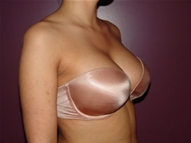 Breast Augmentation After Photo by Moneer Jaibaji, MD; Coronado, CA - Case 23191