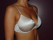 Breast Augmentation Before Photo by Moneer Jaibaji, MD; Coronado, CA - Case 23191