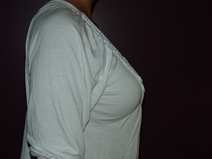 Breast Augmentation Before Photo by Moneer Jaibaji, MD; Coronado, CA - Case 23191