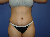 Tummy Tuck After Photo by Moneer Jaibaji, MD; Coronado, CA - Case 23192