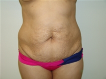 Tummy Tuck Before Photo by Moneer Jaibaji, MD; Coronado, CA - Case 23192